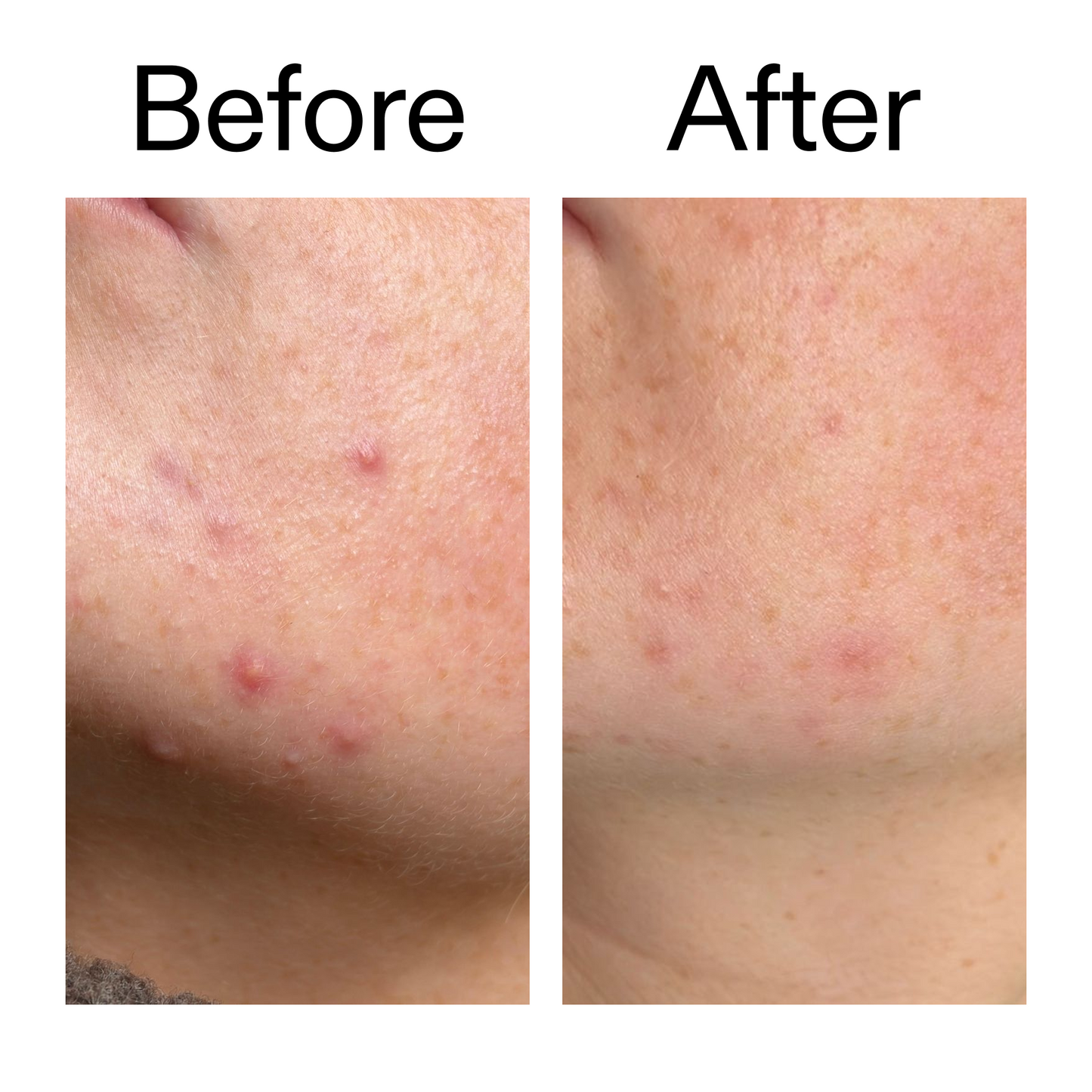 10-azelaic-acid-serum-for-redness-relief-v8 B_A_1_PPAGE.png