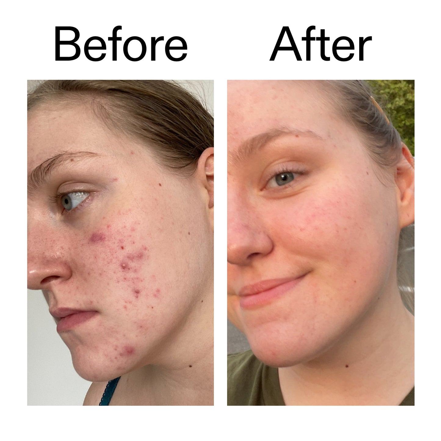 glycolic-acid-toner-u9 Glycolic_Acid_Toner_Before_After_2000x2000_49f0b9f7-e71b-4b2e-a8f8-2ea4b73247bb.jpg