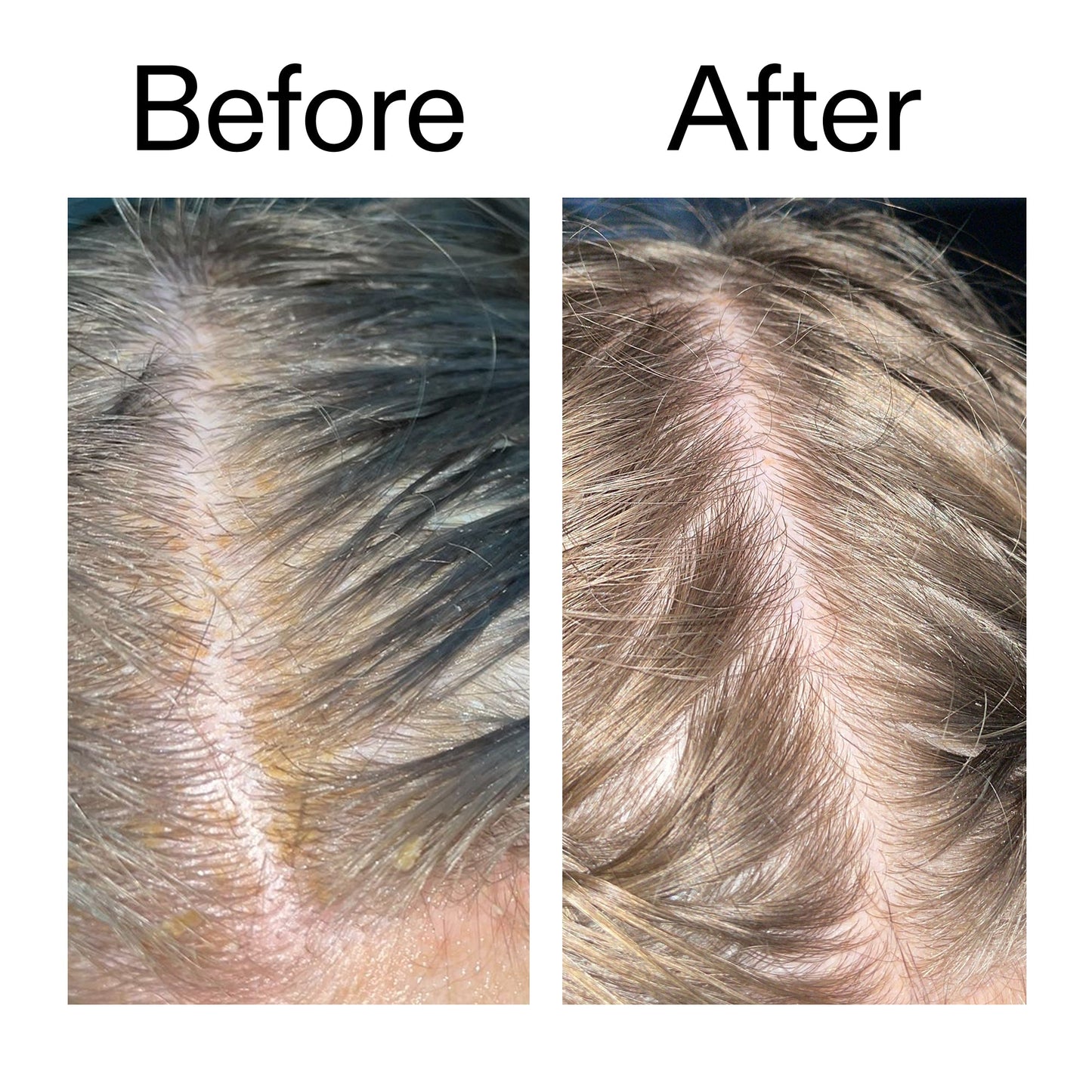 salicylic-acid-exfoliating-scalp-treatment-l7 Salicylic_Acid_Exfoliating_Scalp_Treatment_Before_After_2000x2000_e572a30f-057c-4a48-823b-1c09dc97f8d0.jpg
