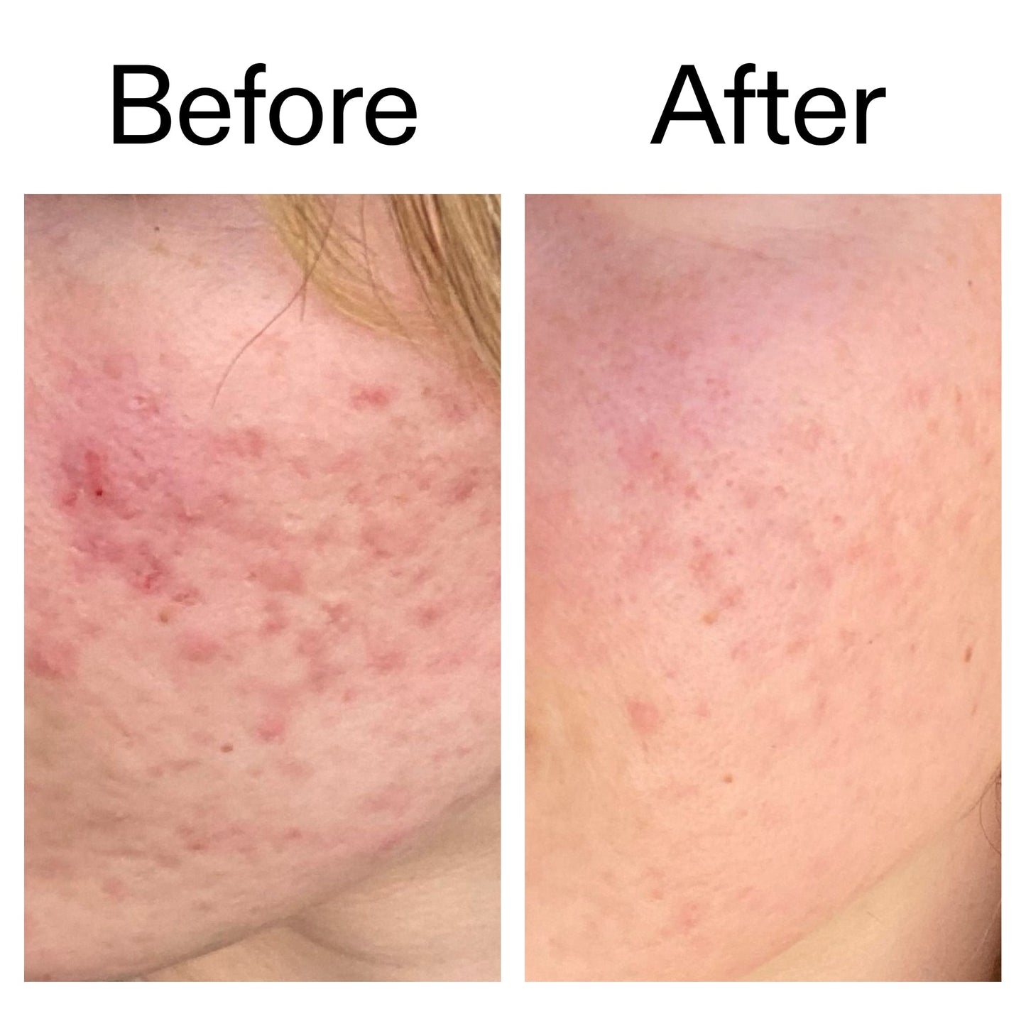 10-azelaic-acid-serum-for-redness-relief-v8 Azealic_Acid_Serum_B_A_Ppage_2000_x_2000.jpg