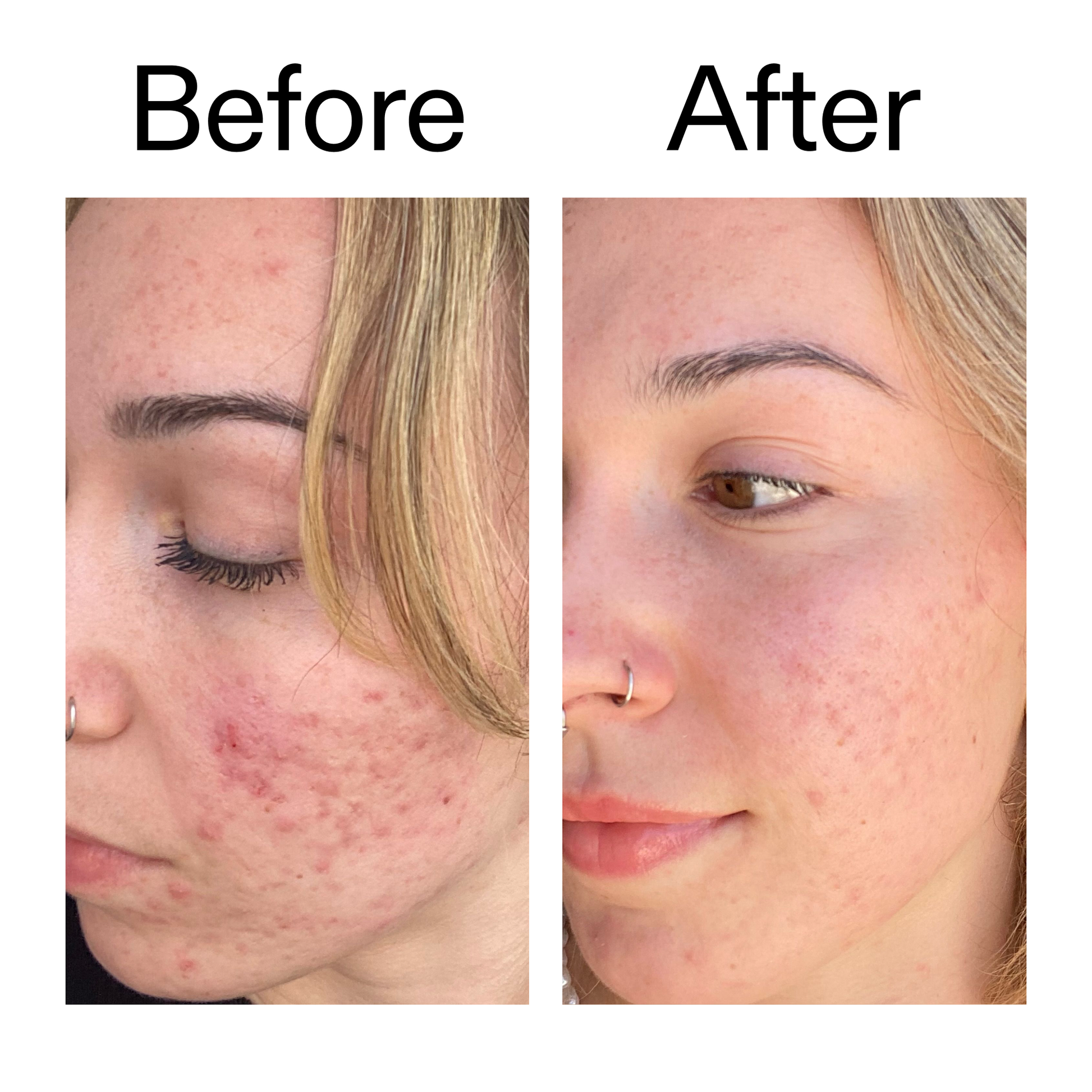 10-azelaic-acid-serum-for-redness-relief-v8 B_A_2_PPAGE.png