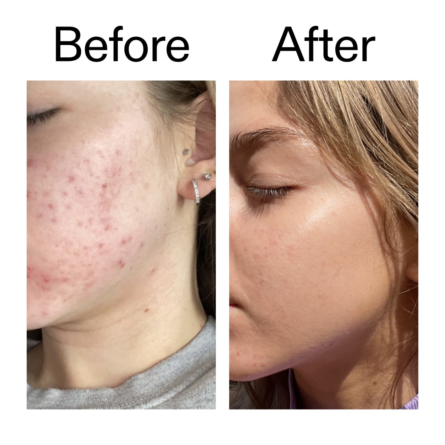 beta-hydroxy-acid-bha-serum-r6 Beta_Hydroxy_Acid_Serum_Before_After_2000x2000_96fda3e5-938d-49ef-bcf2-a0fa6ece4e2c.jpg