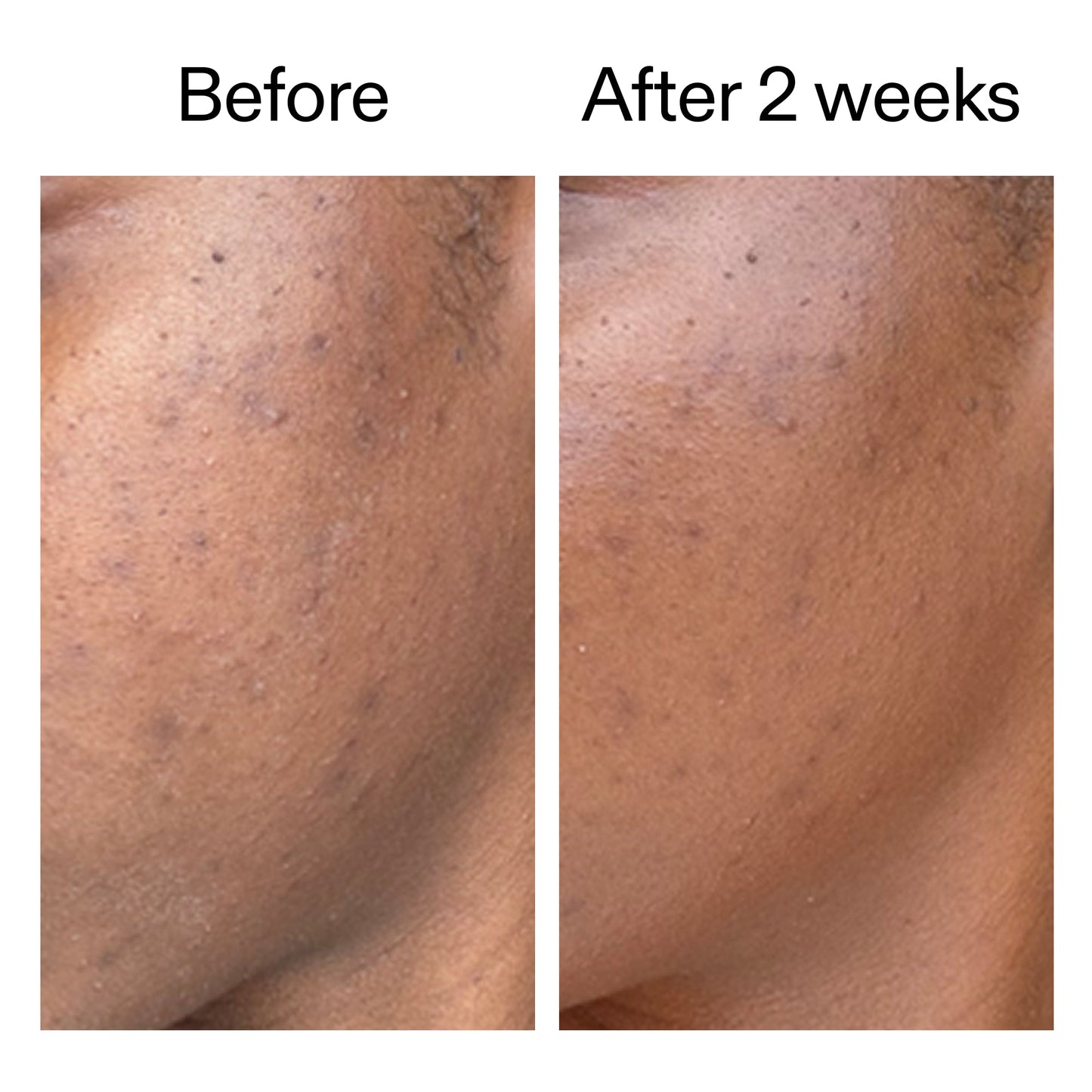 360-acne-clearing-duo-d0 DIOICB_A2000x2000.jpg