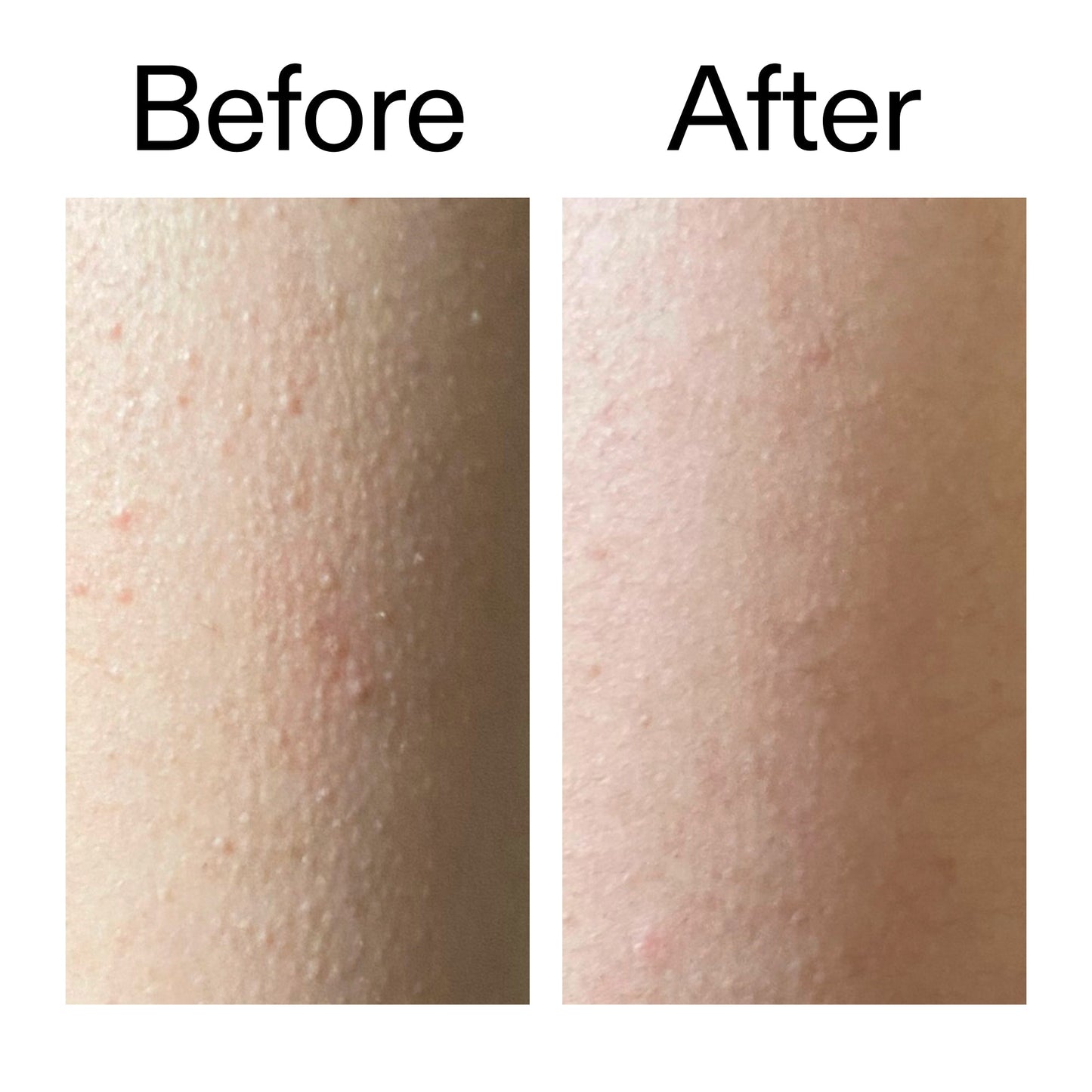 glycolic-acid-exfoliating-body-stick-duo-g5 Glycolic_Acid_Exfoliating_Body_Stick_Before_After_V2_2000x2000_2e4ba052-94f6-4d56-82df-7bdb5b2df7ae.jpg