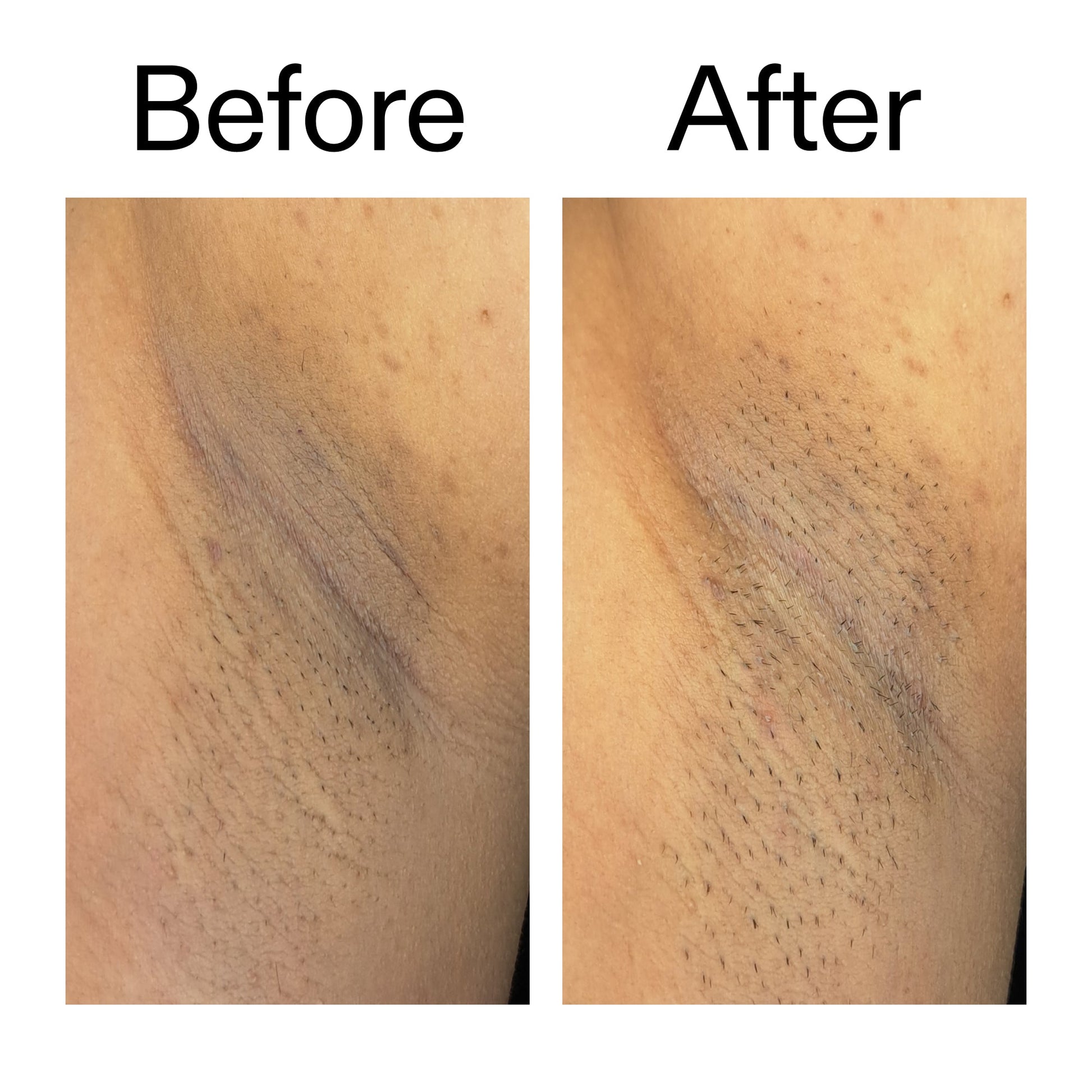 glycolic-acid-exfoliating-body-stick-duo-g5 Glycolic_Acid_Exfoliating_Body_Stick_Before_After_V3_2000x2000_ea919cd9-1439-4a46-82a0-76200eb5bb42.jpg