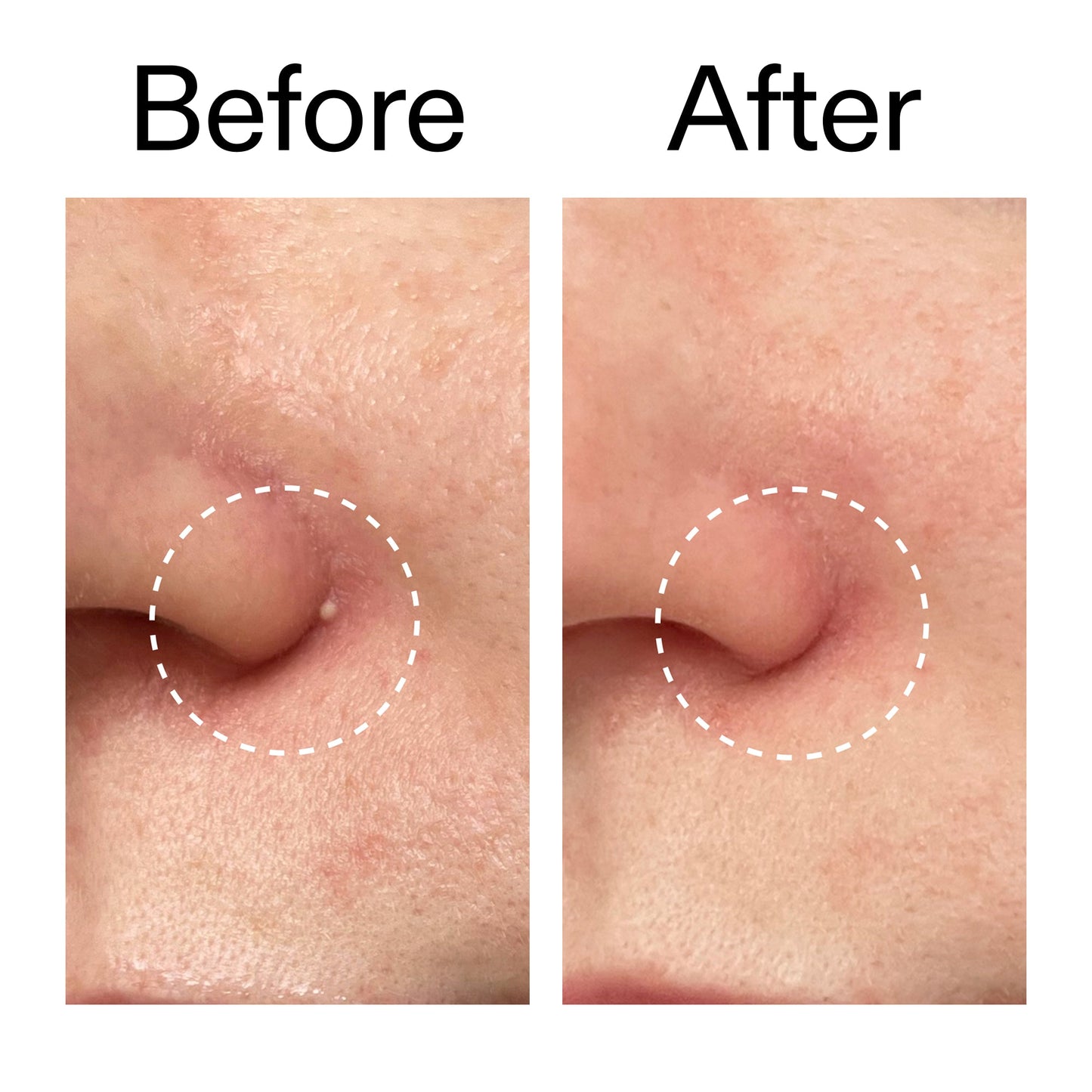 hydrocolloid-invisible-pimple-patches-pack-of-22-y1 Hydrocolloid_Invisible_Pimple_Patches_Before_After_2000x2000_b02aa37b-c78a-4682-91de-9135af5bb7df.jpg