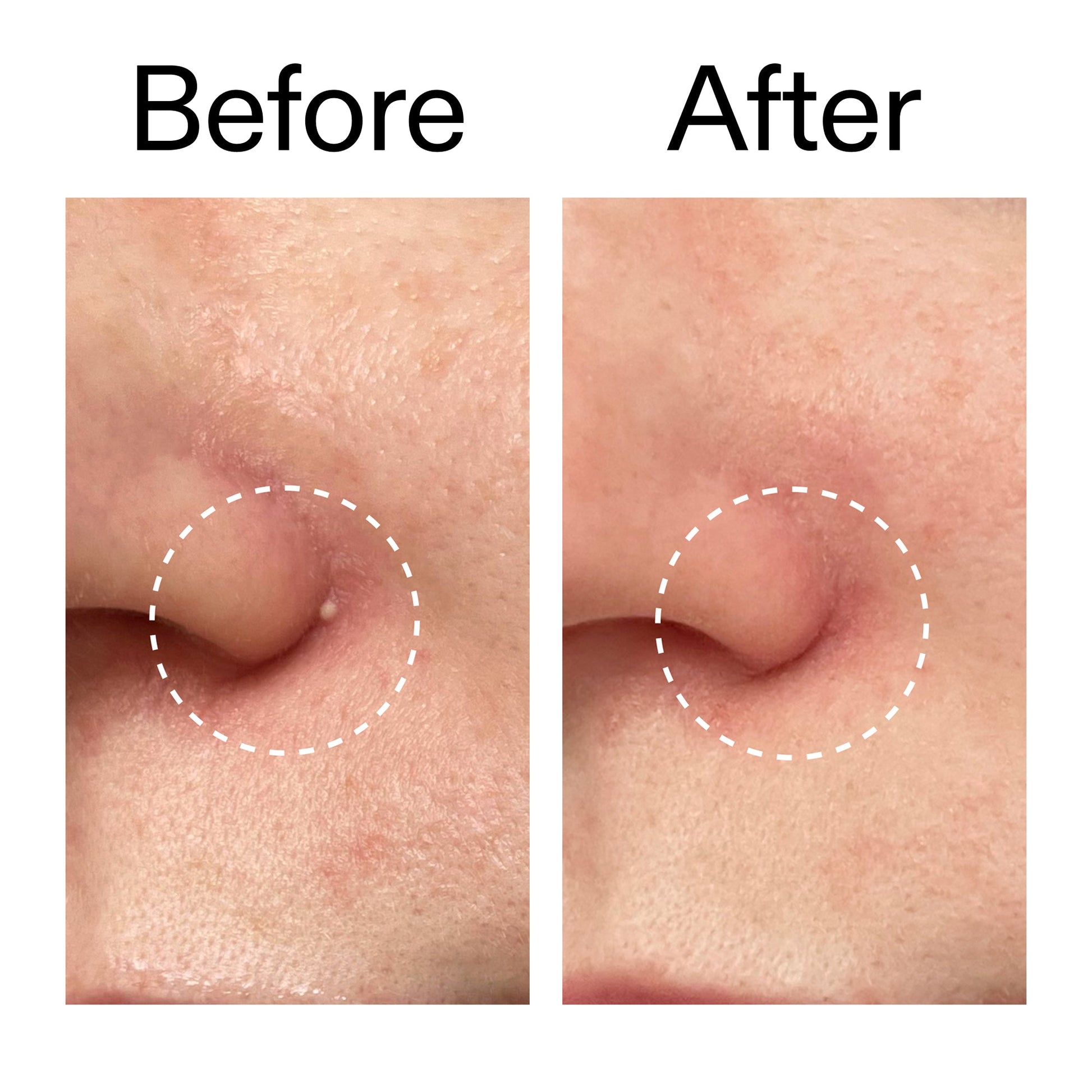 hydrocolloid-invisible-pimple-patches-pack-of-44-k5 Hydrocolloid_Invisible_Pimple_Patches_Before_After_2000x2000_b02aa37b-c78a-4682-91de-9135af5bb7df.jpg