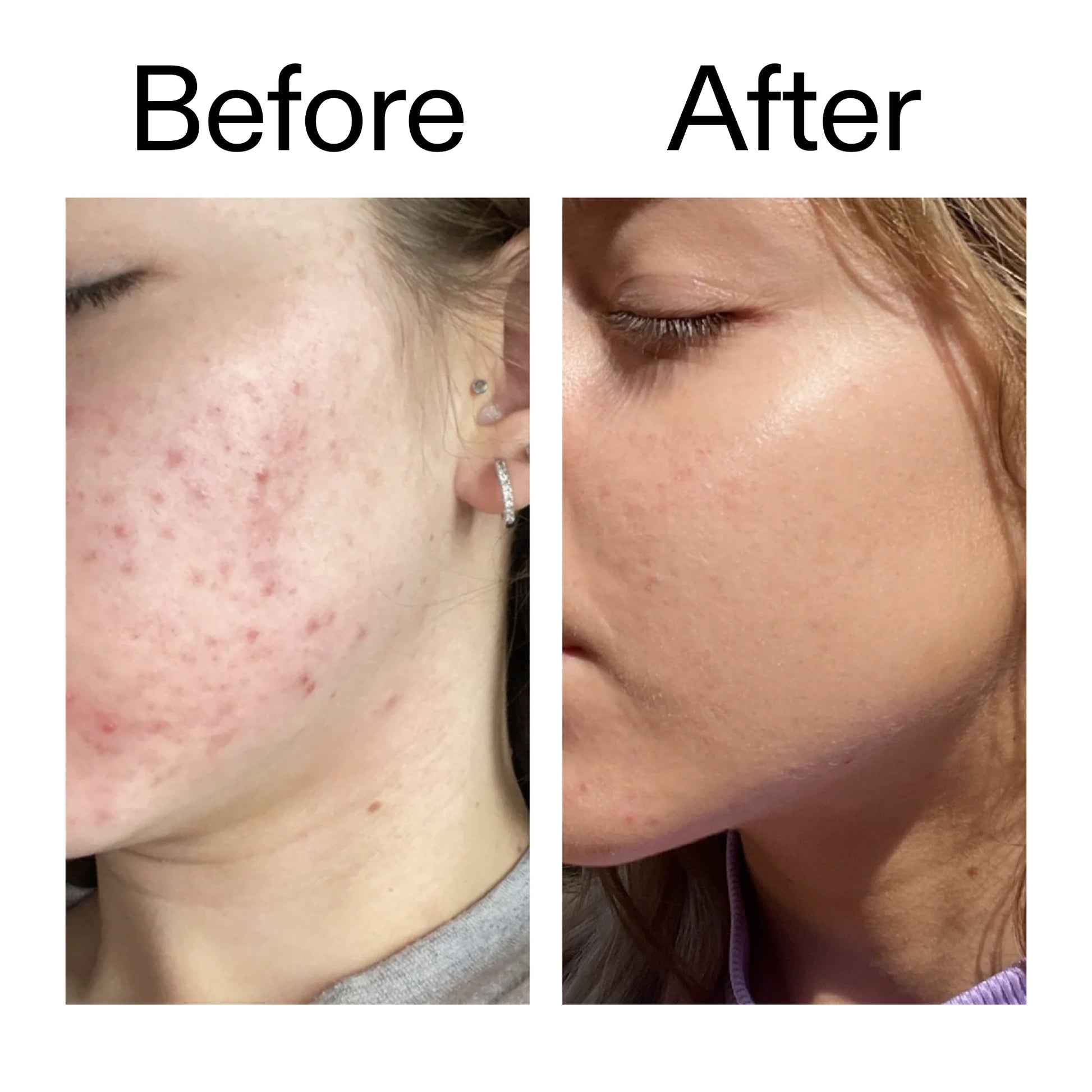 10-niacinamide-serum-z7 Niacinamide_Serum_Before_After_2000x2000_bde32455-9e7d-448e-b053-bef41504f0a9.jpg