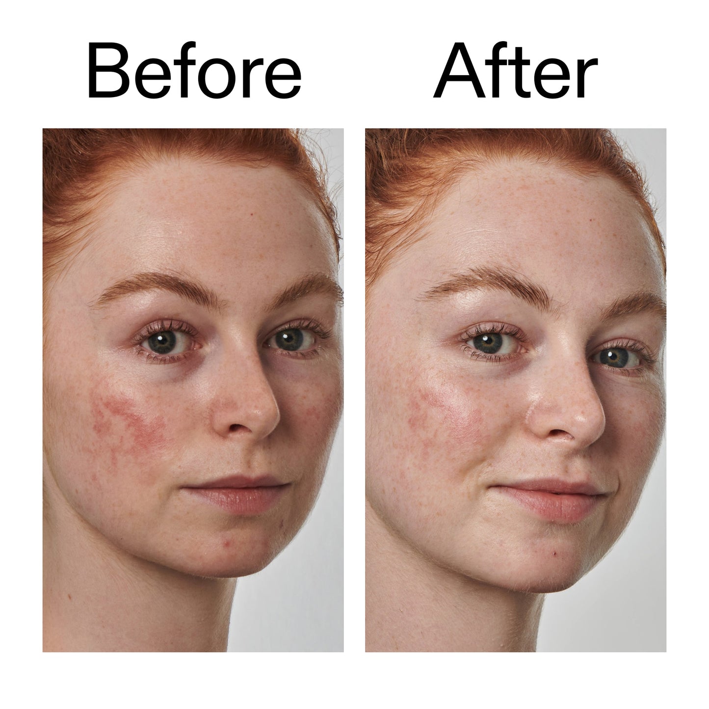 10-azelaic-acid-serum-for-redness-relief-v8 Redness_Relief_Serum_Before_After_2000x2000_3334dc9a-cce9-4e00-8aec-7ad89ca051f2.jpg