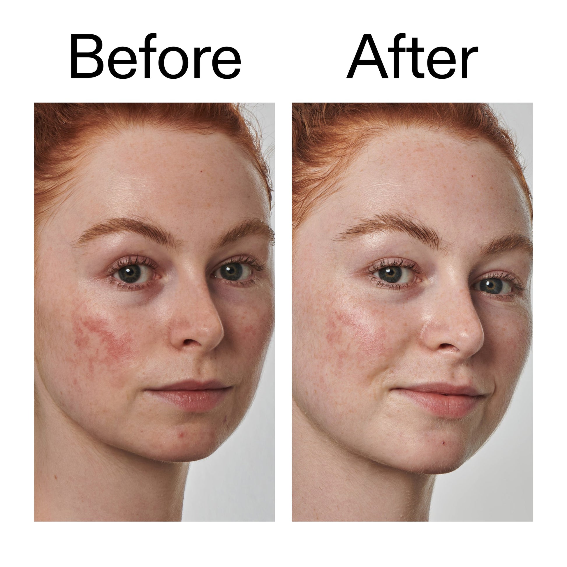 10-azelaic-acid-serum-for-redness-relief-v8 Redness_Relief_Serum_Before_After_2000x2000_3334dc9a-cce9-4e00-8aec-7ad89ca051f2.jpg