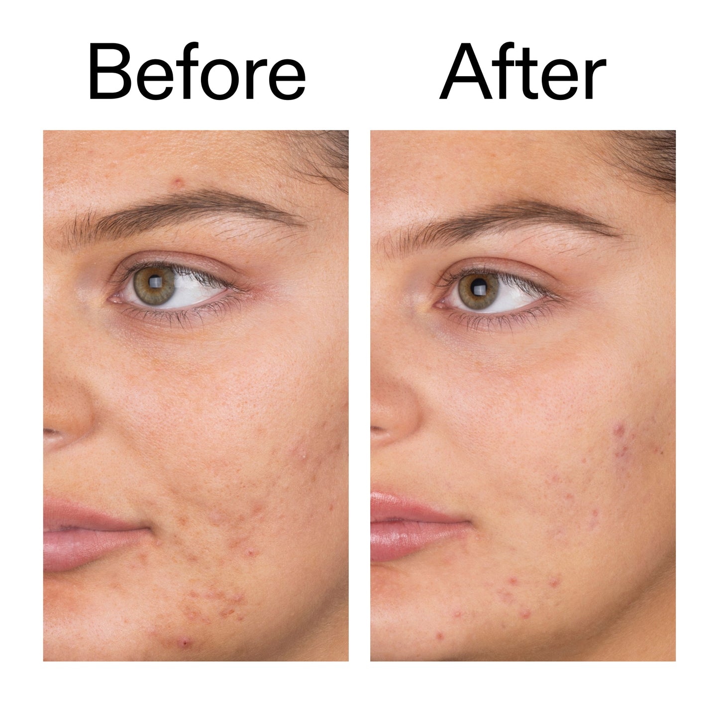 salicylic-acid-cleanser-150ml-x8 Salicylic_Acid_Cleanser_-_150ml_Before_After_2000x2000_e7230494-853f-4b07-82b1-27669104c995.jpg