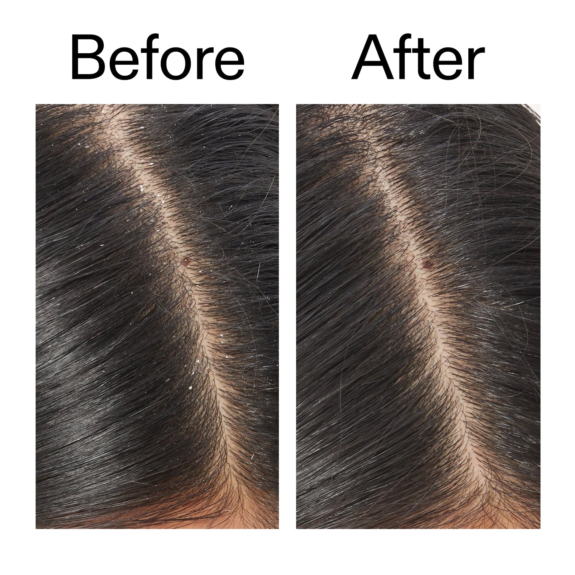 salicylic-acid-exfoliating-scalp-treatment-l7 Salicylic_Acid_Exfoliating_Scalp_Treatment_Before_After_V2_2000x2000_02bd61ad-42bf-490b-b3e3-7e04b2e8a673.jpg