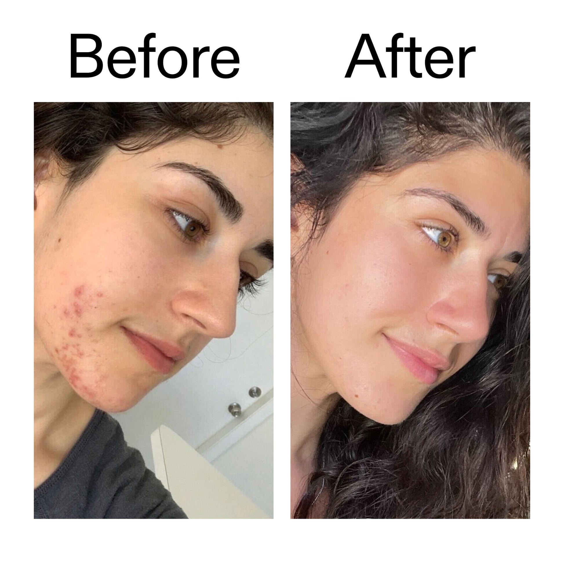 succinic-acid-acne-treatment-b6 Succinic_Acid_Treatment_Before_After_2000x2000_6a5f0054-2f58-4433-9314-0dc72c9bdd3b.jpg