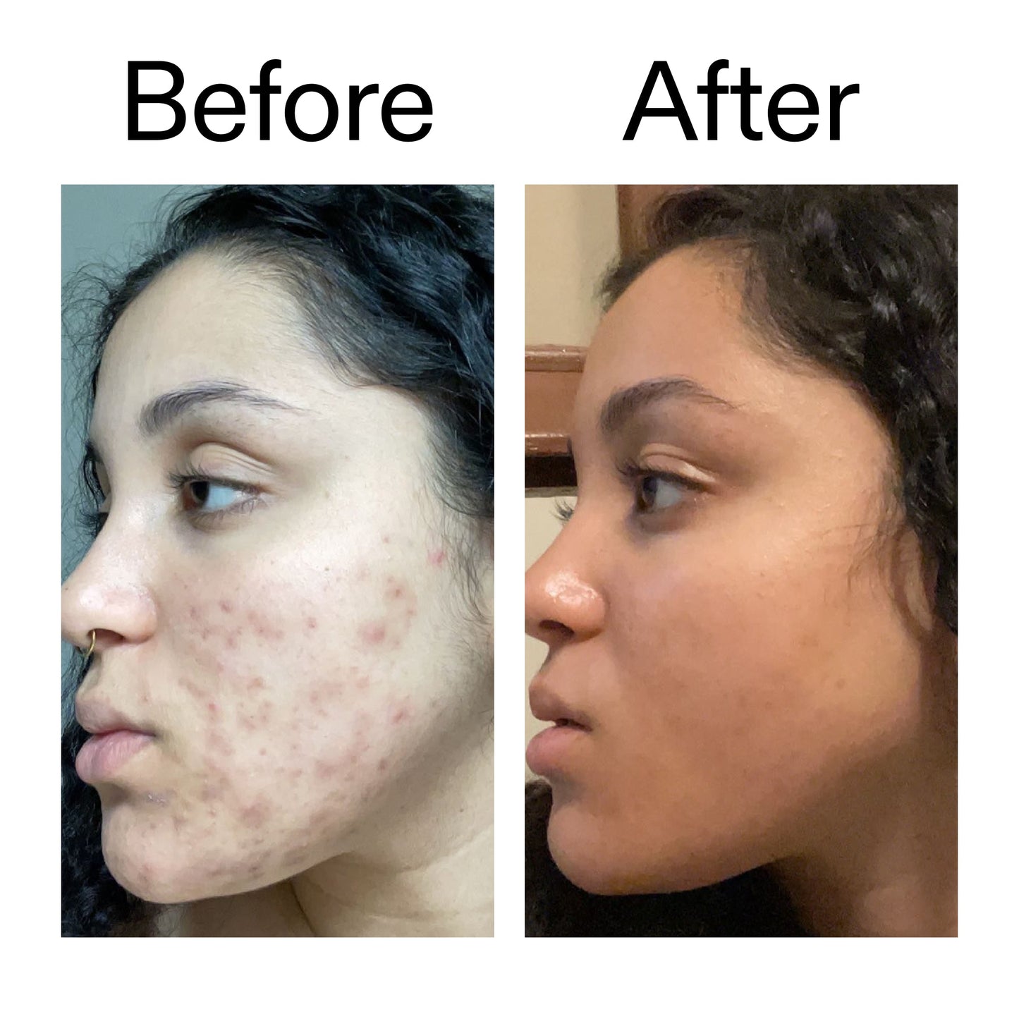 tranexamic-acid-serum-e3 Tranexamic_Acid_Serum_Before_After_2000x2000_98ebc8be-77b0-4843-8a22-90790ebe918b.jpg
